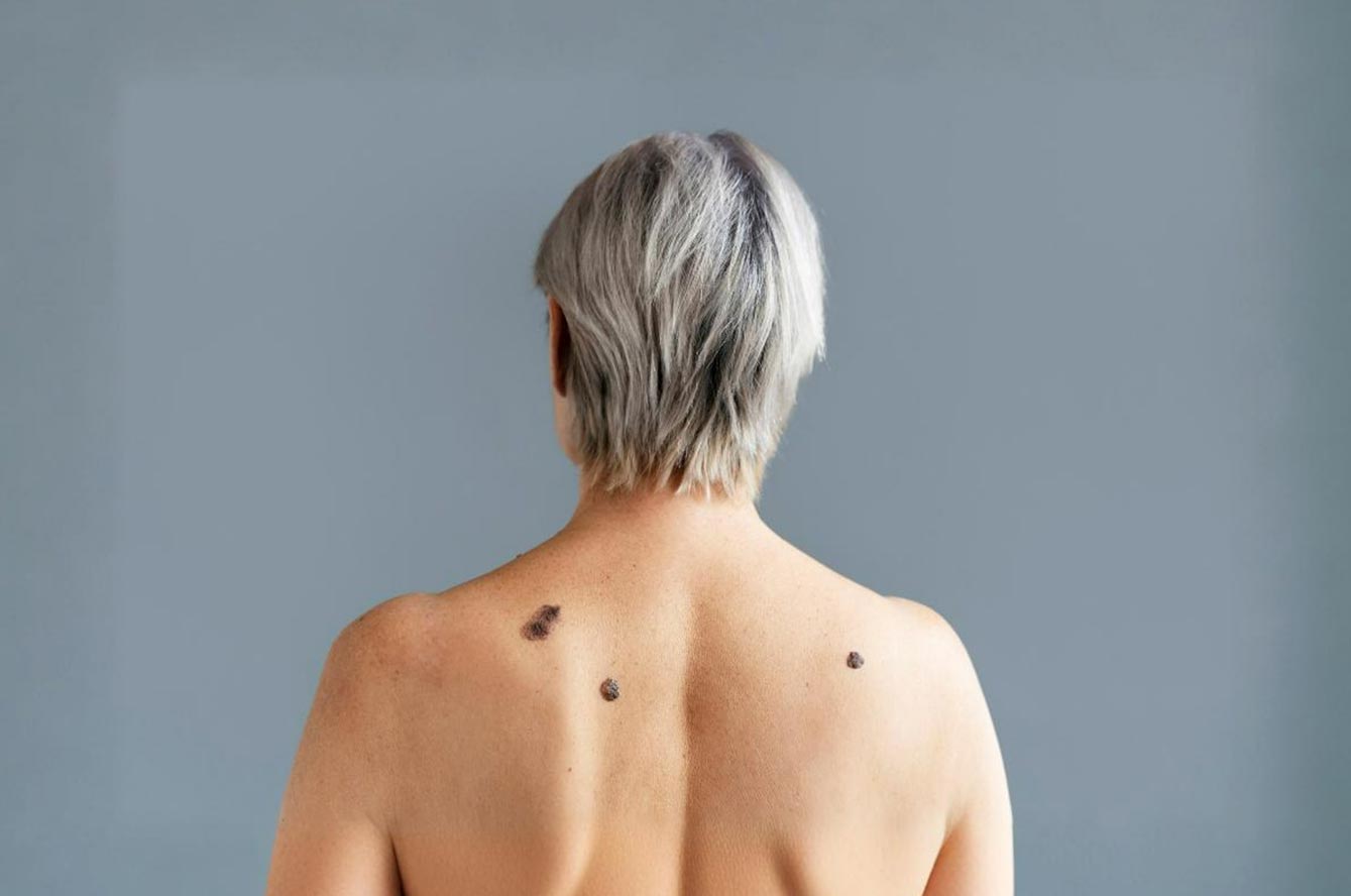 Grains de beauté : comment et pourquoi les surveiller ?