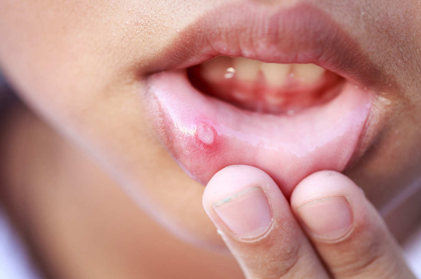 Aphtes dans la bouche : causes et solutions pour les traiter